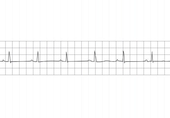 0 تا 100 رپولارریزاسیون-Repolarization