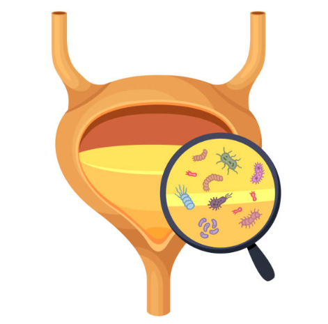 رفلاکس وزیکوورترال (VUR)-vesicoureteral reflux