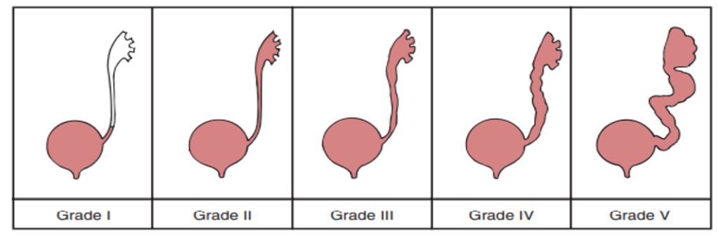 رفلاکس وزیکوورترال (VUR)-vesicoureteral reflux