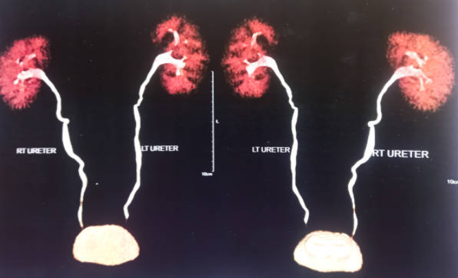 درک هماچوری-hematuria و اطلاعات تکمیلی آن