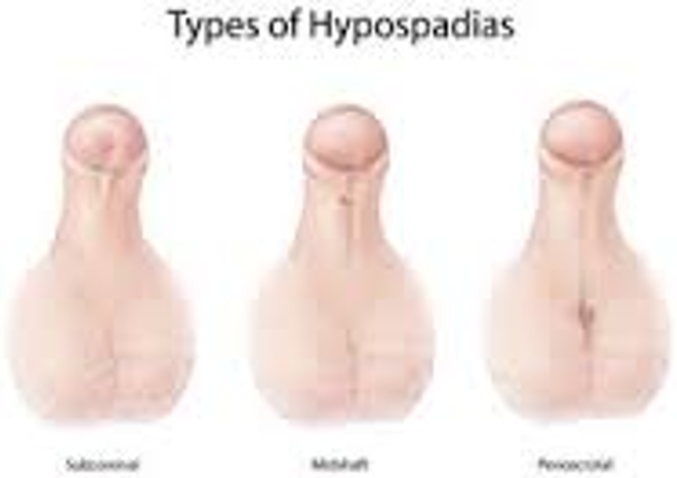 هیپوسپادیاس-Hypospadias-و اطلاعات تکمیلی ان